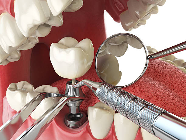 Best Emergency Root Canal Treatment in Mountlake Terrace, WA
